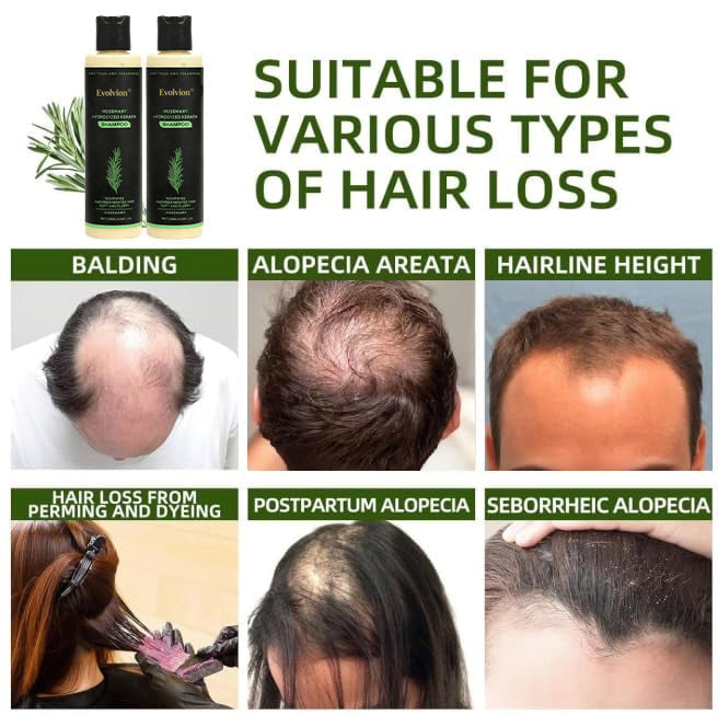 👩‍⚕️𝑶𝒇𝒇𝒊𝒄𝒊𝒂𝒍 𝑺𝒕𝒐𝒓𝒆  |🌱 Organic Rosemary Hair Growth Shampoo